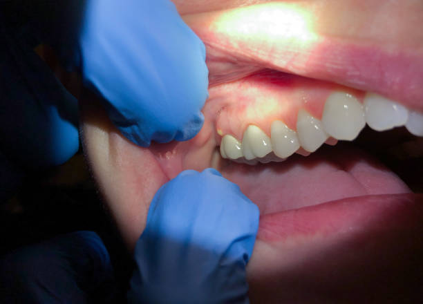Best Emergency Treatment for Oral Infections in Livingston, AL