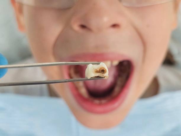 Best Broken or Chipped Tooth Repair in Livingston, AL